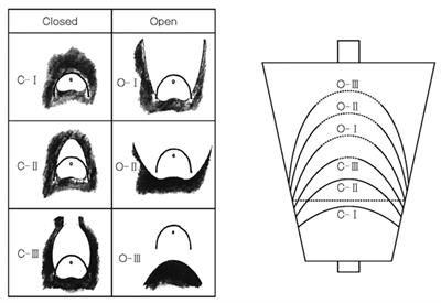 Detection and Characterization of Early Gastric Cancer